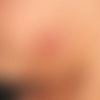 Lymphadenosis cutis benigna: painless, non-itching, calotte-shaped, firm red lump that has been p...