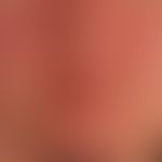 Mixed connective tissue disease: 43 Jahre alte Patientin (mit klinischem Aspekt des systemischen ...