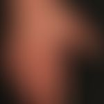 Mixed connective tissue disease: 53 Jahre alte Patientin. Seit mehreren Jahren Raynaud-Syndrom be...