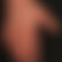 mixed connective tissue disease: 53-year-old female patient. known for several years raynaud synd...