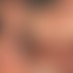 Mixed connective tissue disease: Collage mit Detailabbildungen eines poikilodermatischen Hautzust...