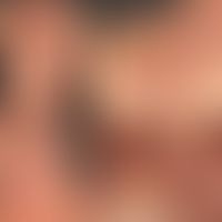Mixed connective tissue disease: Collage with detailed images of a poikilodermatic skin condition...