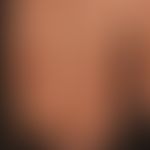 Mixed connective tissue disease: spritzerartige&nbsp; (Ice-pick), weiß-&nbsp;atrophische Narben ü...