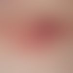 Marginalzonenlymphom primär kutanes:&nbsp;Detailabbildung: rote, oberflächenglatte Papeln und Pla...