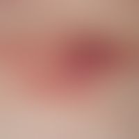 Marginalzonenlymphom primär kutanes:&nbsp;Detailabbildung: rote, oberflächenglatte Papeln und Pla...