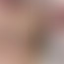 Kutanes Plasmozytom: subkutan und kutan gelegene Knoten. Abb.&nbsp;entnommen&nbsp;aus: Santos G e...