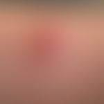 Lymphadenosis cutis benigna: painless, blurredly limited, smooth-surfaced, significantly increase...