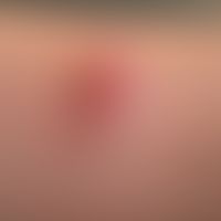 Lymphadenosis cutis benigna: painless, blurredly limited, smooth-surfaced, significantly increase...