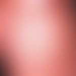 parapsoriasis en plaques, benign small hereditary form. 55-year-old patient with small spotted pa...