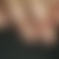 Paronychie chronische: chronische Candida-Paronychie. Pat. mit ständigen Feuchtarbeiten.
