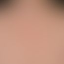 Malasseziafollikulitis:&nbsp;disseminierte, follikelgebundene entzündliche Papeln und Papulopuste...