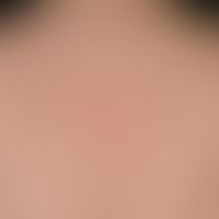 Malasseziafolliculitis: disseminated, follicle-bound inflammatory papules and papulopustules on t...