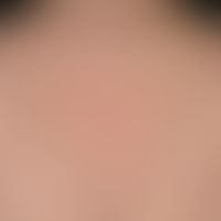 Pityrosporumfolliculitis (malasseziafolliculitis): disseminated, follicle-bound inflammatory papu...
