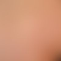 Pityriasis versicolor alba. close-up, spatter-like, in places confluent depigmentations with fine...