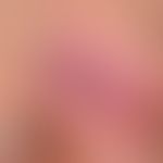 Carbuncle: palm-sized, highly painful inflammatory swelling with lymphadenitis and fever. Inlet: ...