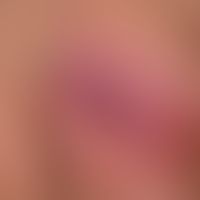 Pyoderma: Carbuncles.
