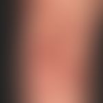 Ekthyma. Multiple, an beiden Unterschenkeln akut aufgetretene,&nbsp;disseminierte, 0,4-2,0 cm gro...