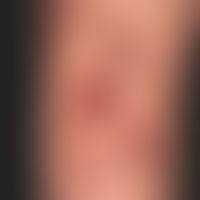 Ekthyma. Multiple, an beiden Unterschenkeln akut aufgetretene,&nbsp;disseminierte, 0,4-2,0 cm gro...