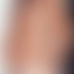 Pityriasis rosea. truncated, in the skin tension lines arranged (see following figure), thick mac...