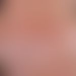 pityriasis rosea. exanthema occurred within a few days. course in the skin tension lines (drawn h...