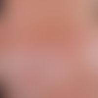 Pityriasis rosea. Exanthem innerhalb von wenigen Tagen aufgetreten. Verlauf in den Hautspannugnsl...