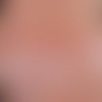 pityriasis rosea. exanthema occurring within a few days, intermittently intermittent with dissemi...