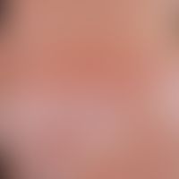 Pityriasis rosea. Innerhalb von wenigen Tagen auftretendes, intwischen schubweise verlaufendes&nb...