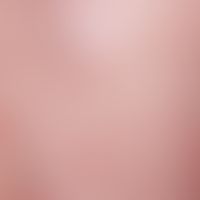 Pityriasis rosea (Nahaufnahme): disseminierte, bis&nbsp;2,0 cm große, stellenweise kräftig&nbsp;s...