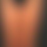 Pityriasis lichenoides chronica: 16 jährige, ansonsten gesunde&nbsp;Patientin, mit einem seit meh...
