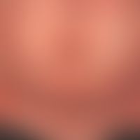 Pityriasis rubra pilaris (adult type) Detail: chronic recurrent course for years with phases of m...