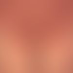 Pityriasis rubra pilaris (adult type) Detailed view: chronic recurrent course for years with phas...
