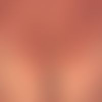 Pityriasis rubra pilaris (adult type) Detailed view: chronic recurrent course for years with phas...