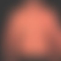 Pityriasis rubra pilaris (adult type): chronic recurrent course for years with phases of marked i...