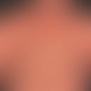 Pityriasis rubra pilaris (adult type): chronic recurrent course for years with phases of marked i...