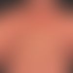 Pityriasis rubra pilaris (adult type): chronic recurrent course for years with phases of marked i...