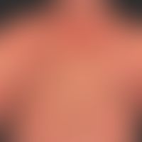 Pityriasis rubra pilaris (adult type): chronic recurrent course for years with phases of marked i...