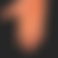 Pityriasis rubra pilaris (adulter Typ): zum Handgelenk hin&nbsp; scharf abgesetzte (Unterschied z...