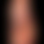Pityriasis rubra pilaris (juveniler Typ): diffuse, völlig symptomlose, kleinschuppige&nbsp;Planta...