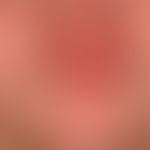 Pityriasis rubra pilaris (juveniler Typ): wechselhafte gelb-orange gefärbte, nur optisch störende...