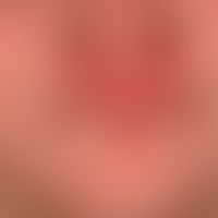 Pityriasis rubra pilaris (juvenile type): variable yellow-orange coloured, only optically disturb...
