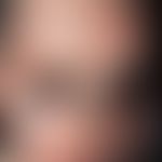 Pityriasis rubra pilaris (juveniler Typ): Harlekin-artige randbetonte gelb-orange-gefärbte, sympt...