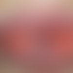 Angiom seniles der Lippen: sog. Lippenrandangiom. Harmloser, bläulicher, weicher und exprimierbar...