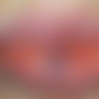 Angiom seniles der Lippen: sog. Lippenrandangiom. Harmloser, bläulicher, weicher und exprimierbar...