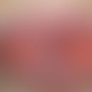 Phlebektasie. Sog. Lippenrandangiom. Harmloser, bläulicher, weicher und exprimierbarer Knoten der...