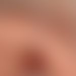 Phlebektasia (venous lake): completely compressible, symptom-free, blue vasectasia at the edge of...
