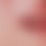 Phlebektasia (Venous lake also lip margin angioma): Symptomless, soft bluish, completely expressi...