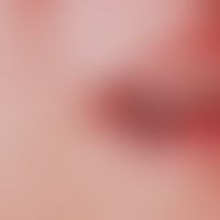 Phlebektasia (Venous lake also lip margin angioma): Symptomless, soft bluish, completely expressi...