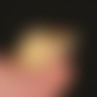 Onychogrypose bei Psoriasis: komplett geänderte, nur noch vertikal ausgerichtete Wachstumsrichtun...
