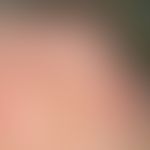 Pseudozyste der Aurikula: innerhalb von 4-6 Wochen&nbsp;(traumatisches Ereignis nicht erinnerlich...