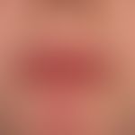 Peutz-Jeghers Syndrome. black-brown, splatter-like brown spots on the lips and in the frontal are...